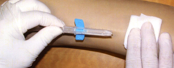 Nipro SafeTouch Tulip Safety Fistula Needle Engaged