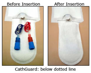 Cathguard Patient Catheter Protective Pocket